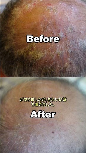 乾癬（同一部位）治療前→治療後｜症例写真比較｜ソウル