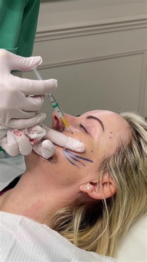 Understanding aesPlla® Treatment for Natural Skin Rejuvenation