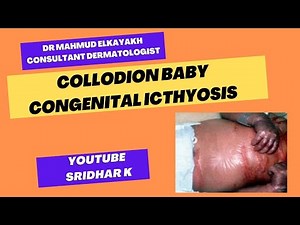 Collodion baby l Congenital Icthyosis #collodionbaby