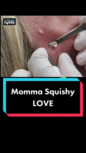 If you don’t know abt Momma Squishy & her Steatocystomas, 😉 you’re welcome. #drpimplepopper #SLMDskincare