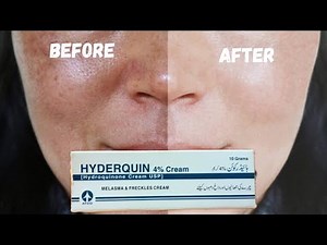 HYDROQUINONE | Benefits and side effects | How to use correctly