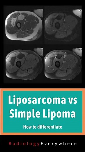 How to differentiate liposarcoma from lipoma | MSK Radiology | 1000 cases in 100 days | video 41