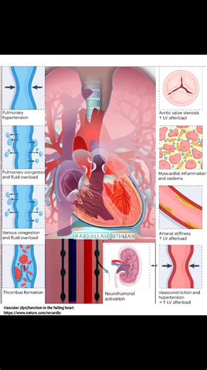 HF: It's not just a weak pump. New review highlights how vascular dysfunction—arterial stiffness, microvascular issues, and neurohumoral activation—drives heart failure (HF) progression, not just weak heart muscle. 🩸 Impaired blood flow → worsened metabolism & function 🔄 Vicious cycle: HF damages vessels, vessels worsen HF. 💡 Targeting vascular health (with meds & interventions) is key for all HF types. #CardioTwitter #HeartFailure #VascularHealth #Cardiology | Abdallah Othman
