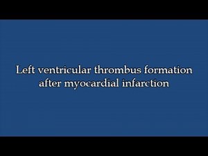 Left ventricular thrombus after myocardial infarction