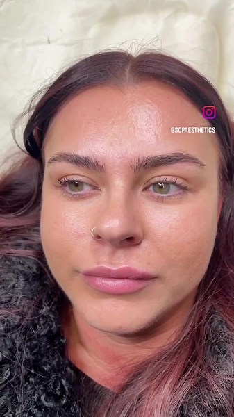 2 Week Post Bocouture Treatment Results | Wrinkle-Free Transformation