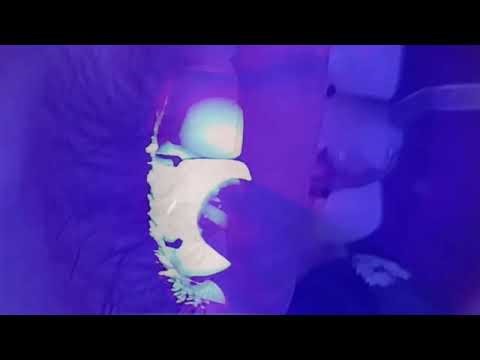 Fiber Post & Composite Build-Up | Step by Step Restoration