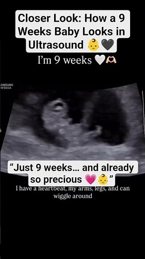 Closer Look: How a 9 Weeks Baby Looks in Ultrasound 👶🖤 #firsttrimester #shorts