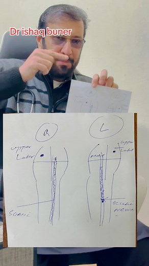 85K views · 3.7K reactions | Post injection neuritis #AFP | Dr Ishaq’s Foundation | Facebook