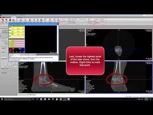 CubeVue - TALAS - Automatic Hindfoot Alignment Measurement Tool for Weight Bearing CT