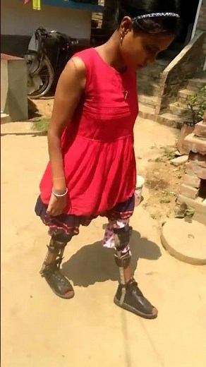 Polio handicapped girl with clubfeet.