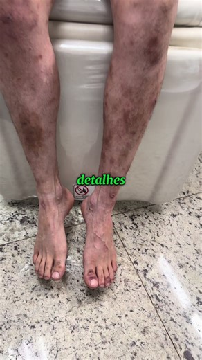 Ele me procurou por causa de caroços que coçavam muito nas pernas. O diagnóstico inicial era prurigo nodular — e sim, o tratamento para isso era necessário. Mas eu sempre digo: a pele fala… e os nervos também. Durante o exame criterioso, identifiquei: ✔️ Mancha hipocrômica com perda de sensibilidade ✔️ Áreas de anestesia no pé ✔️ Espessamento do nervo fibular superficial direito Isso não podia ser ignorado. Recomendei investigação para hanseníase. Resultado: 🔎 Teste rápido POSITIVO 🔎 Ultrassom