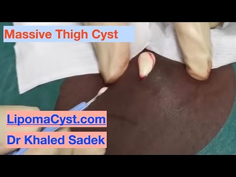 Massive Cyst Rupture. Dr Khaled Sadek. LipomaCyst.com