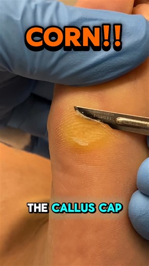Hard corn and callus under the 5th metatarsal head? This one can be particularly tender because it sits right under a high-pressure area on the outside of the forefoot. In this video, our podiatrist carefully removes the hard callus using a number 15 blade. The approach depends on the history: • If it’s the first visit, we can usually gauge how sensitive it’s likely to be and remove a substantial amount safely. • If it was very tender last time, we may leave a small amount behind to avoid causin