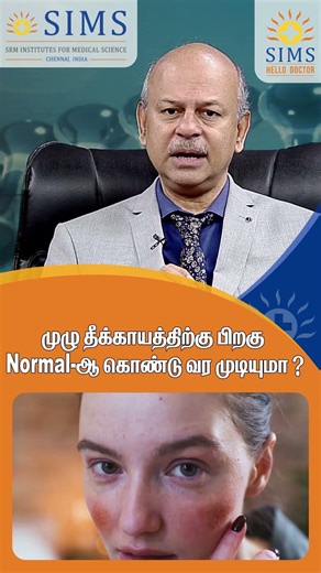 Can a Person Fully Recover After a Severe Burn Injury? | Hello Doctor