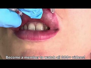 Simple Lip Filler Injection – Real-Time Procedure