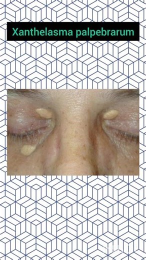 Xanthelasma palpebrarum Pretibial myxedema#medicine #medicalstudent#skin#dermatology#skincare