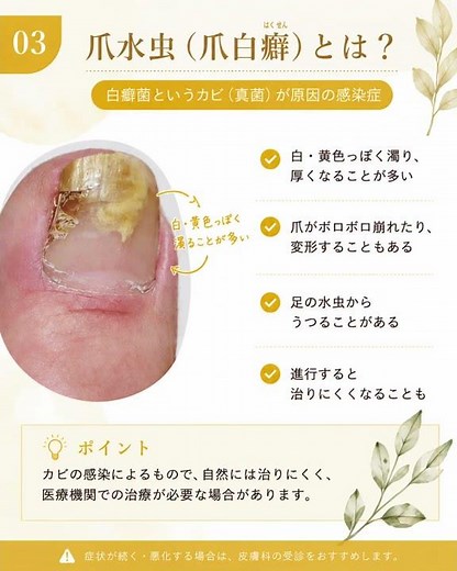 それって爪水虫？グリーンネイル？ #ネイル #グリーンネイル #爪水虫 #ネイルケア #大源製薬