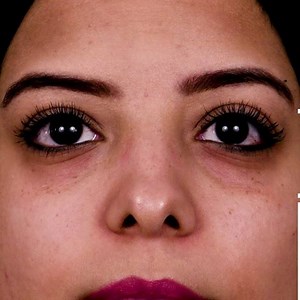 52K views · 124 reactions | Tear trough correction using Hyaluronic acid filler done by Dr. Nehal El Helaly | Skinova Dermatology & Laser Clinics | Facebook