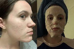 'I spent thousands on managing my cystic acne. This is what worked for me.'