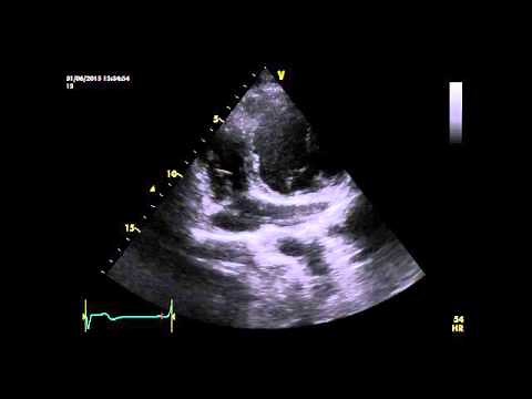 Vena cava superior izquierda persistente - Ecocardiografía