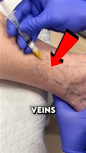 How spider veins get treated 😷