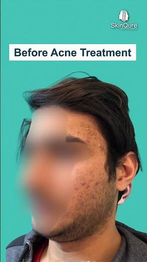 Acne Treatment Results | Before & After Clear Skin Transformation