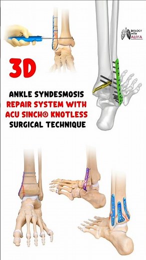 ankle syndesmosis repair system with acu sinch® knotless surgical technique #medical #3d #short