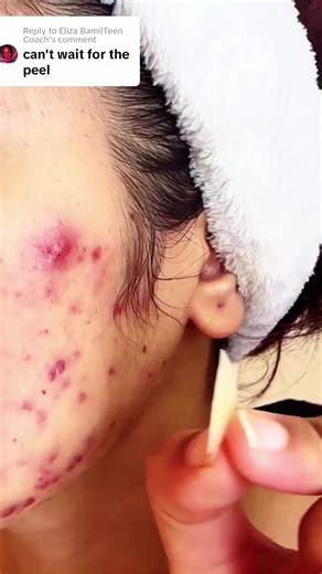 Satisfying Pimple Patch Removal: A Gross but Effective Acne Treatment