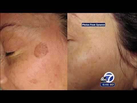 PicoWay Laser for Skin: Remove Tattoos and Brown Spots | The Plastic Surgery Clinic