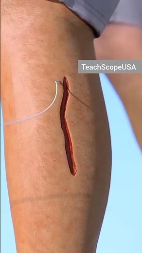 "How Stitches Heal Your Skin: The Science of Wound Recovery"