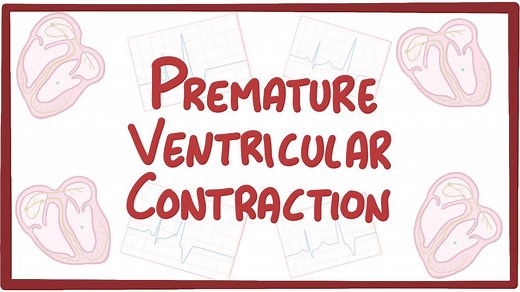 Premature ventricular contraction: Video, Causes, & Meaning | Osmosis