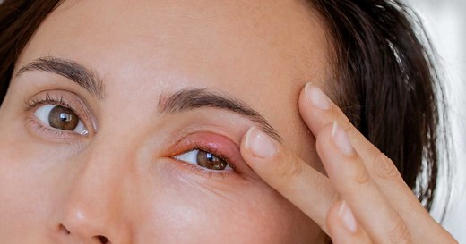 Orgelet à l'œil : combien de temps dure-t-il et comment le soigner ?