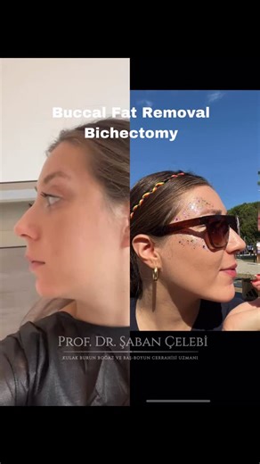 Prof. Dr. Şaban Çelebi | With Bichectomy surgery, we can make your cheeks less chubby . By removing the buccal fat with a small incision made inside the mouth .... | Instagram
