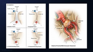 #325: Pterional Craniotomy for Clipping of a Ruptured, Incompletely Coiled Middle Cerebral Artery Aneurysm - All Videos - Seven Series Collection