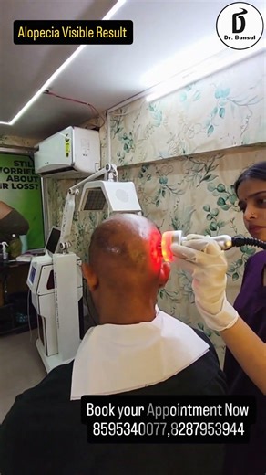 Alopecia Areata Explained: Causes, Symptoms, and Effective Treatments with Dr. Bansal