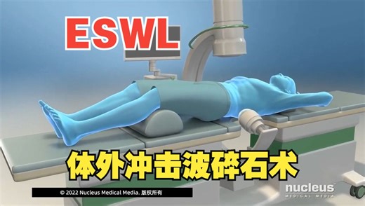 【3D医学动画】体外冲击波碎石术(ESWL)