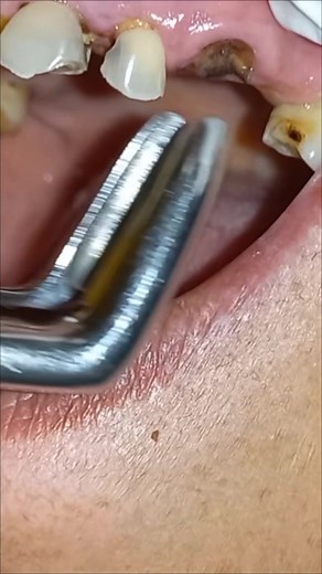 Tooth Root Removal Process Explained