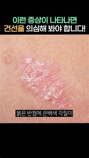 이런 증상이라면 '건선'을 의심해 봐야 합니다!👀 | #건선 #건선피부