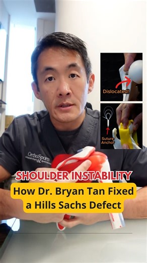 Dr Bryan Tan | Shoulder and Sports Surgeon on Instagram: "In our last video, Dr Bryan explained how a Bankart lesion is repaired. Today, he breaks down how a Hill-Sachs defect is treated. If all these medical terms sound confusing, don’t worry — Dr Bryan makes it simple. Catch the full Shoulder Instability Series on YouTube! 🔗 Link in bio. #askdrbryantan #orthopaedicsurgeon #shoulderinjury #shoulderpain #orthopaedicsurgery #sportsinjury #shouderinstability #shoulderdislocation"