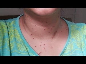 My Warts Removal Laser Treatment experience | Perkymegs