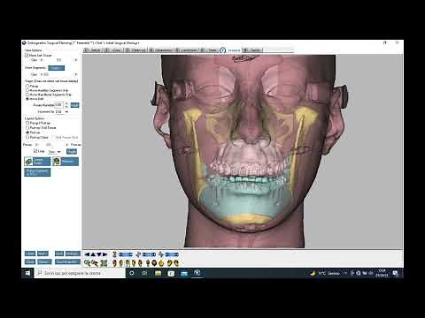 VSP - Virtual Surgical Planning orthognathic Dolphin