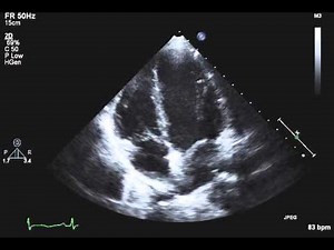 TTE Normal Apical 4 chamber Example 1