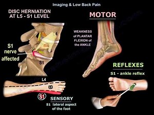 Imaging in Low Back Pain Explained • Video • MEDtube.net
