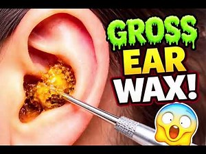 Safe Removal of Impacted Cerumen with Immediate Restoration of Hearing.