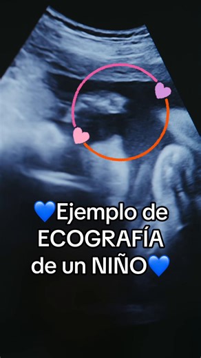 Ecografía Abdominal con Método RaMzi: Ejemplo Visual