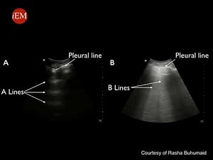 Video 13 A normal and B abnormal lines in the lung US