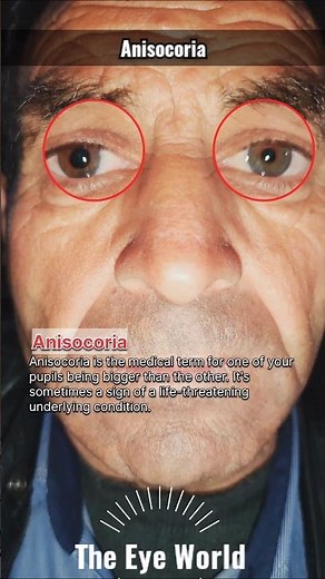Anisocoria post trauma #eyes #ophthalmology