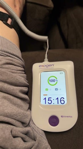 Exogen bone stimulator prescribed after femoral intramedullary nail surgery.