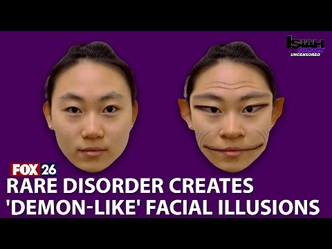 Rare 'demon face' syndrome