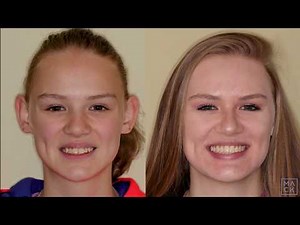 Traditional braces to fix SEVERE Overjet (overbite)